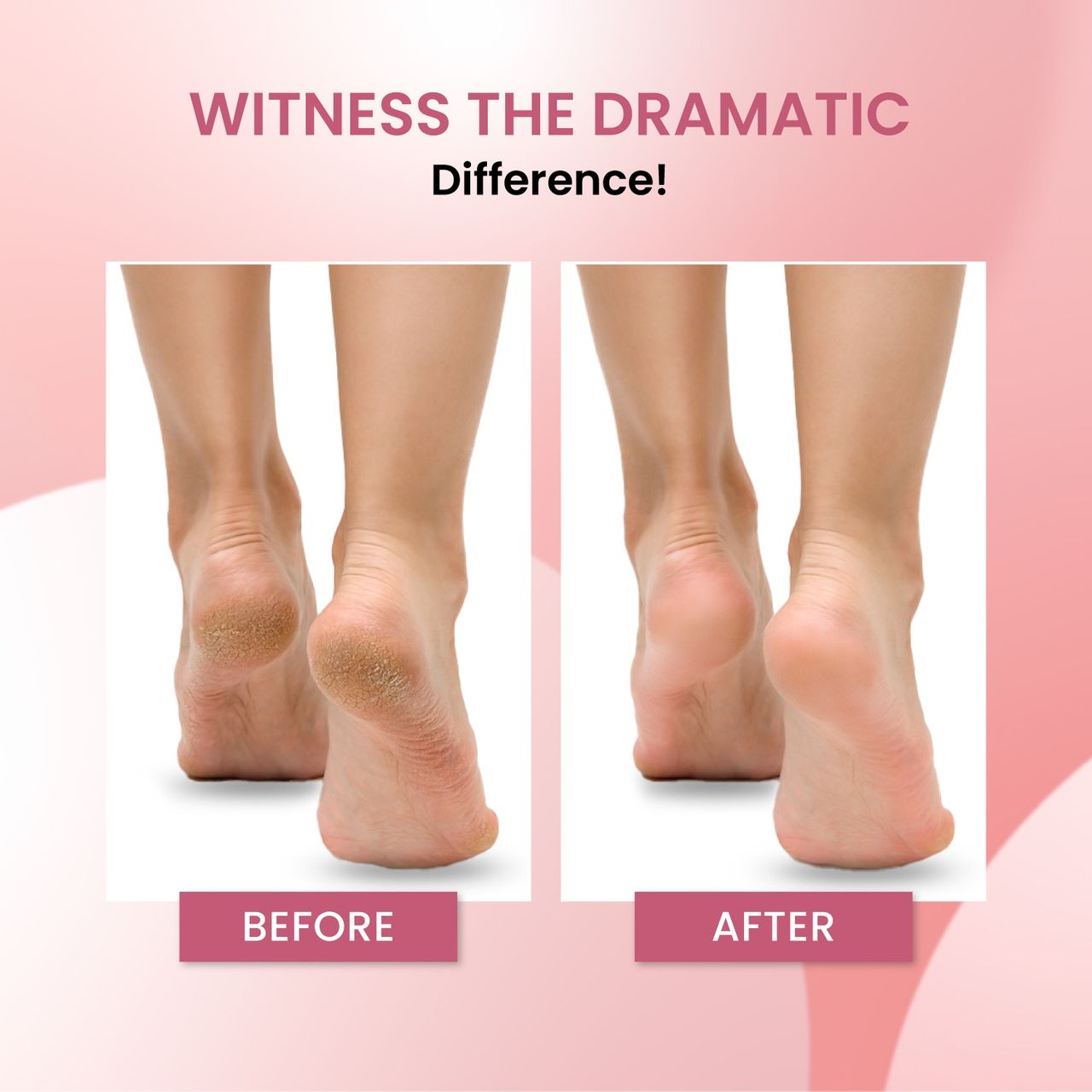 UrbanYog Electric Callus Remover  2 Speed Settings | 1200 mAh Battery