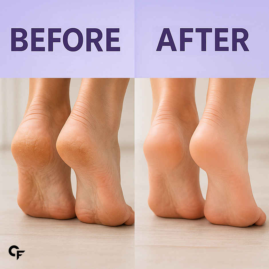 Carbamide Forte 20% Urea Foot Cream Roll-On | Feet Roll On | Foot Rollon | Urea Foot Cream