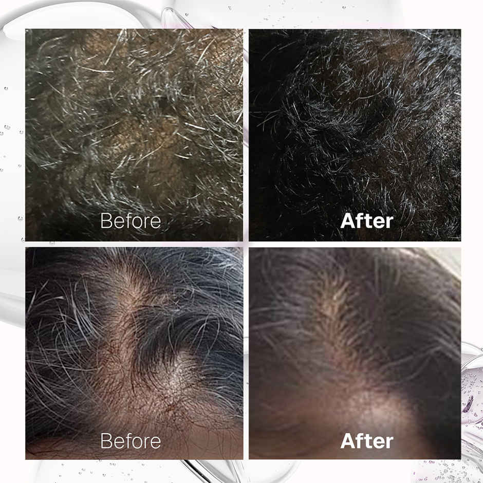 Bontress Pro + Scalp Serum 30 Ml|Fortified With Redensyl,Procapil,Capixly & Anagain