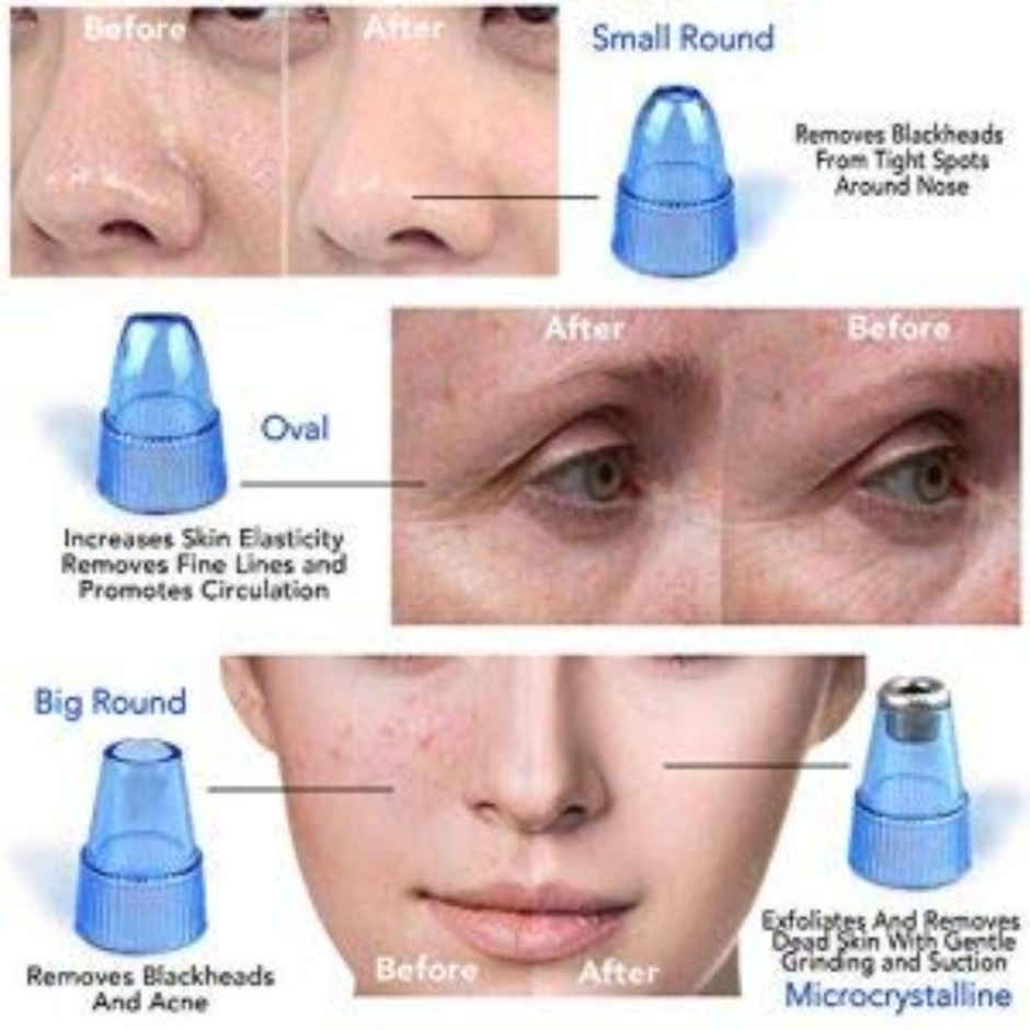 Bronson Professional Pore Cleanser Blackhead Derma Suction Remover Battery Operated With Nozzles