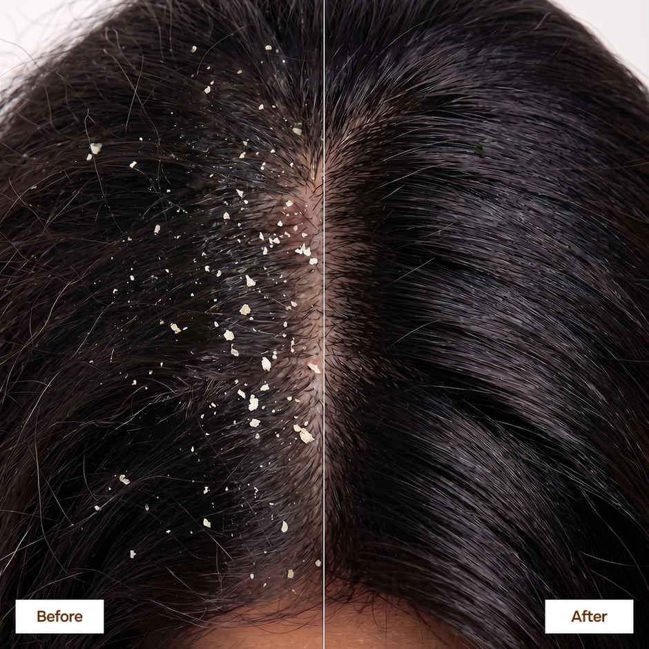 EleGanz Professional ScalpMatrix Anti-Dandruff Shampoo | Salicylic Acid + Dandrilys