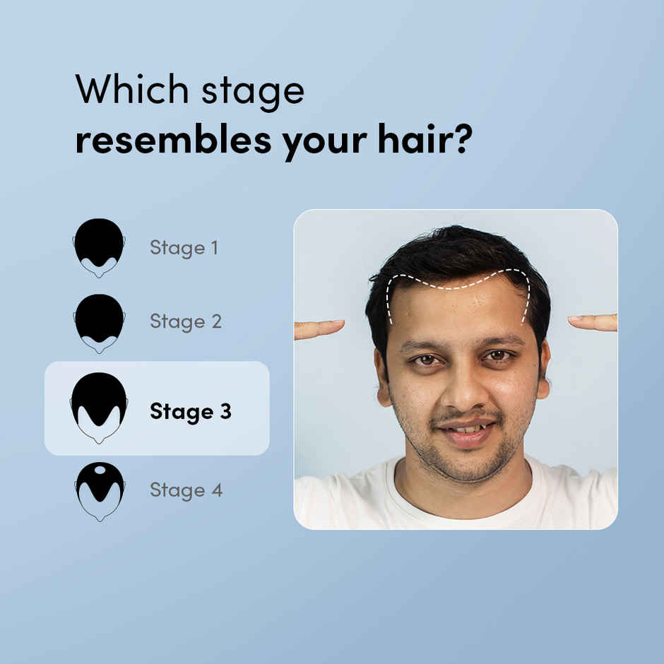 Man Matters Minoxifin Topical Solution | 5% minoxidil and 0.1% Finasteride | For stage 3 hairfall