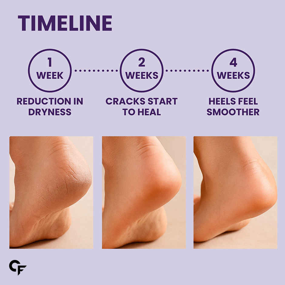 Carbamide Forte 20% Urea Foot Cream Roll-On | Feet Roll On | Foot Rollon | Urea Foot Cream