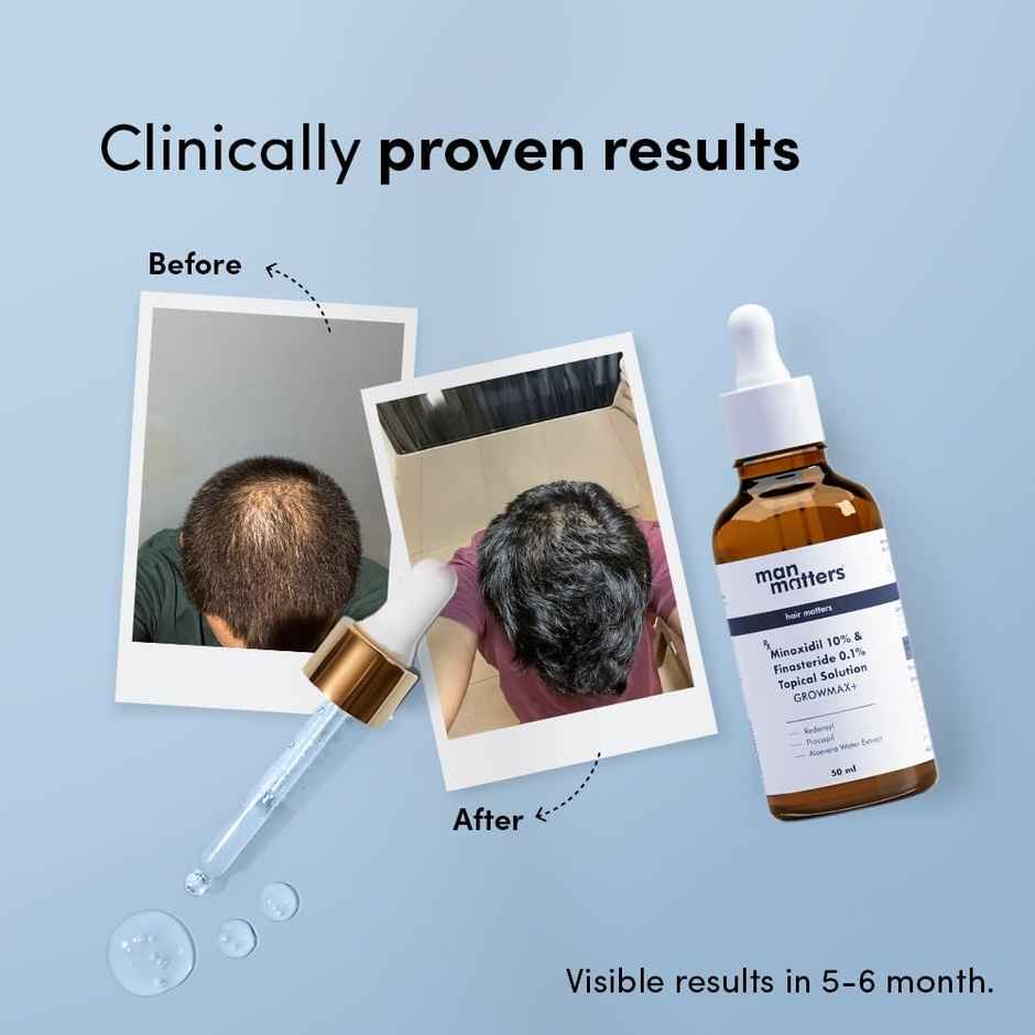 Man Matters GrowMax+ 10% Minoxidil Topical Solution | for stage 4 hairfall