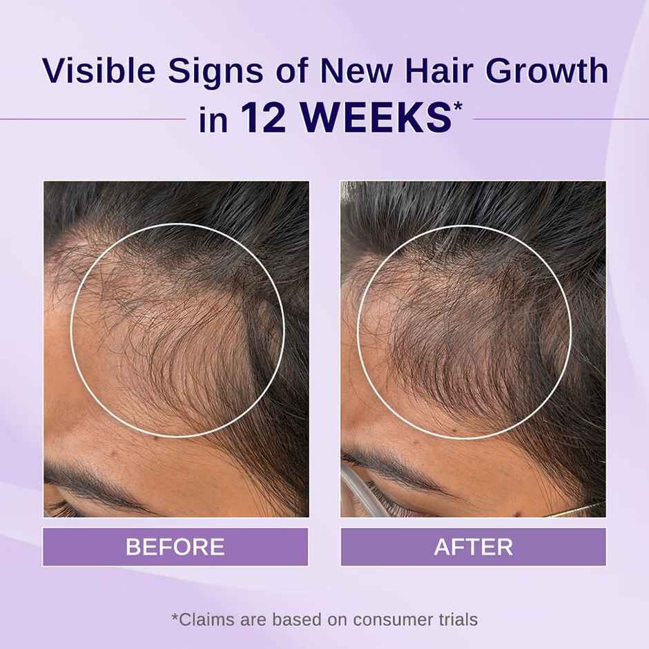 Bare Anatomy Rosemary Hibiscus Hair Growth Oil Nourishes, Strengthens & Controls Hair Fall