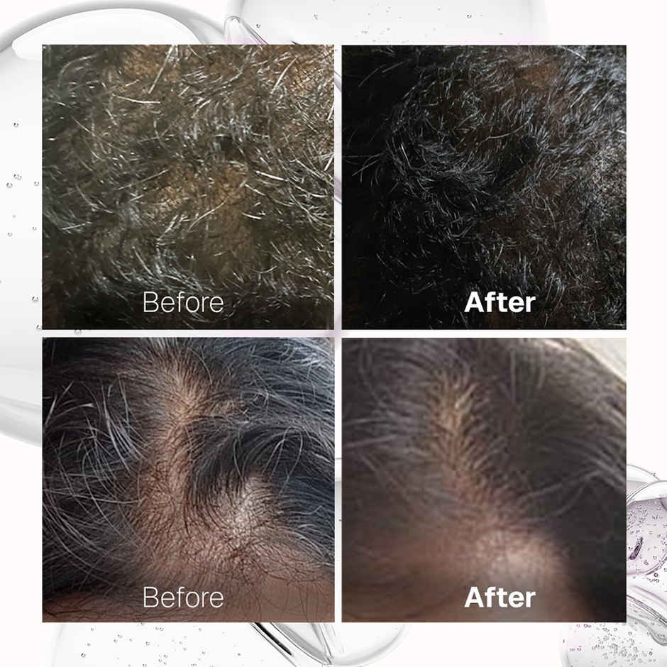 Bontress Pro + Scalp Serum