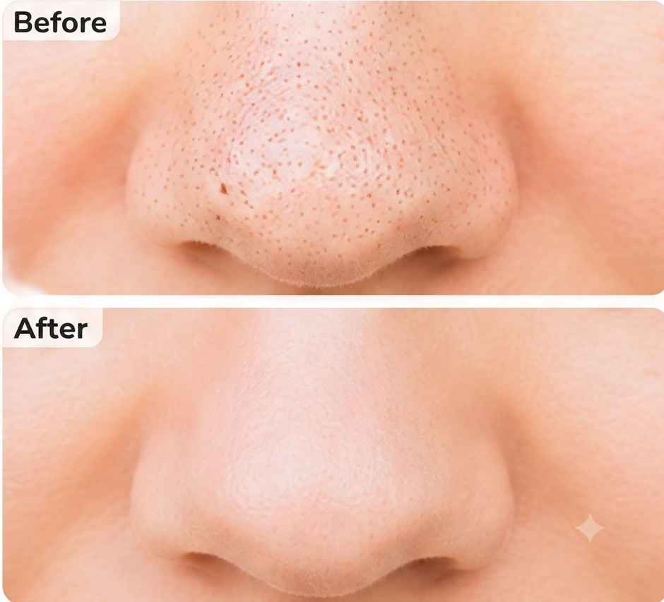 Beautiliss Blackhead Remover Round Tool for Clear Smooth Skin and Effective Pore Cleaning