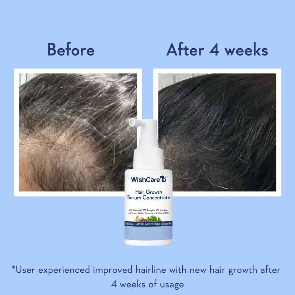 WishCare Hair Serum Concentrate|New Hair Growth & Reduced Hairfall|Redensyl, Anagain & Rosemary