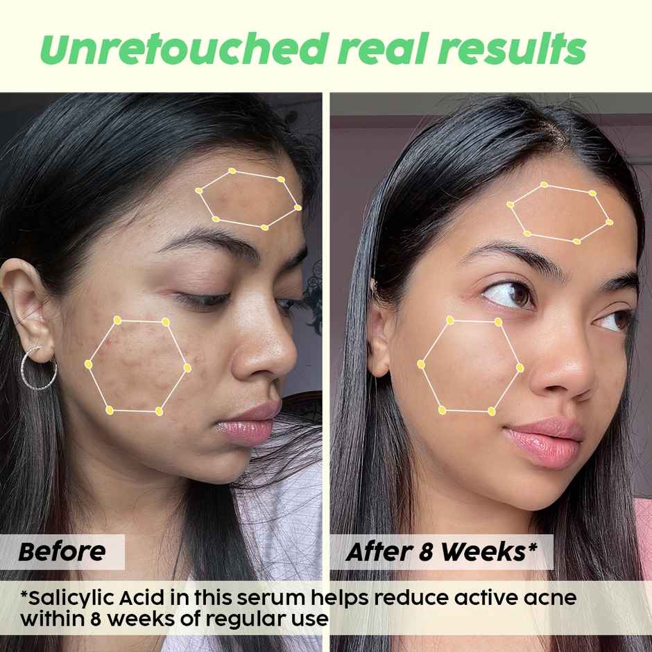 Plix The Plant Fix Jamun 2% Salicylic Acid Exfoliating Face Serum | For Active Acne & Blackheads