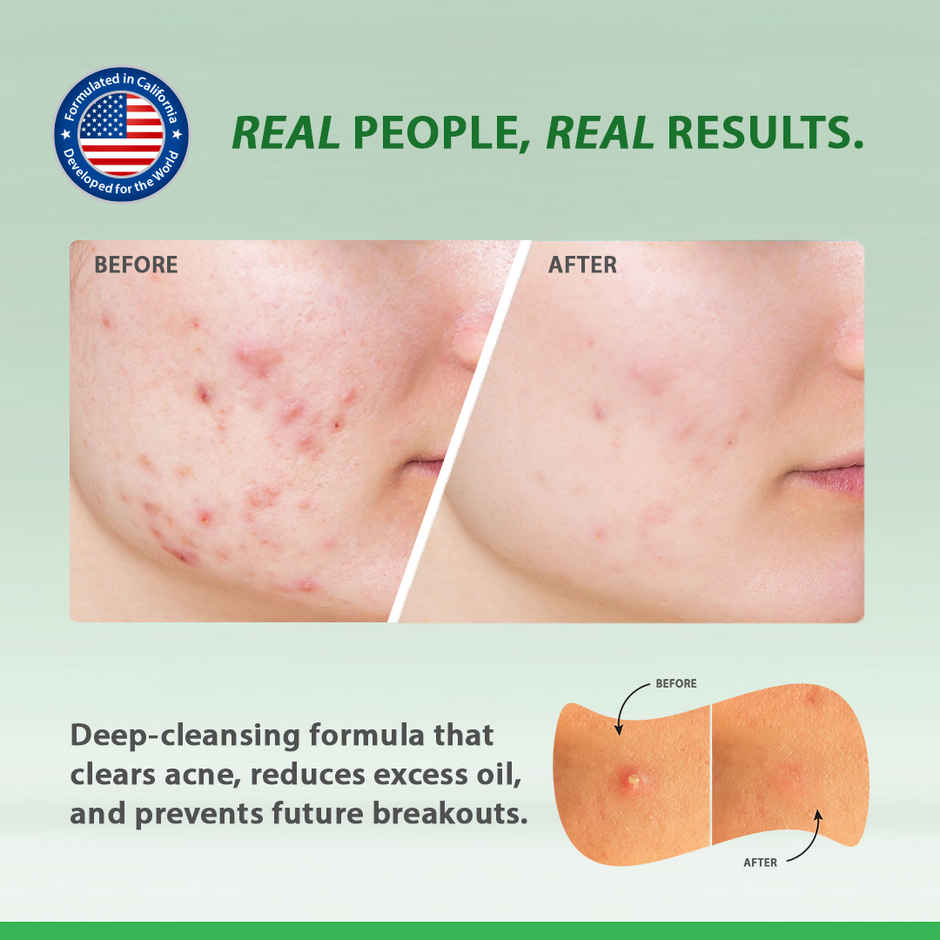 California Skin+ One Hour Acne Spot Relief