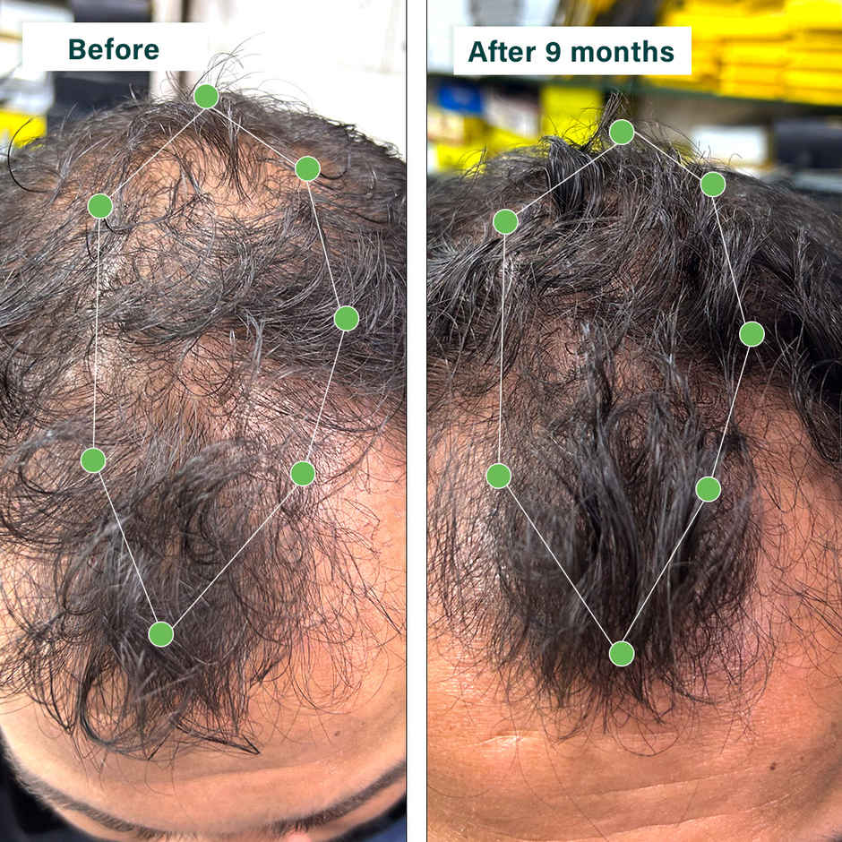 Oziva Hair Vitamins with Biotin, Iron and DHT Blocker for Hair Growth and Hairfall Control