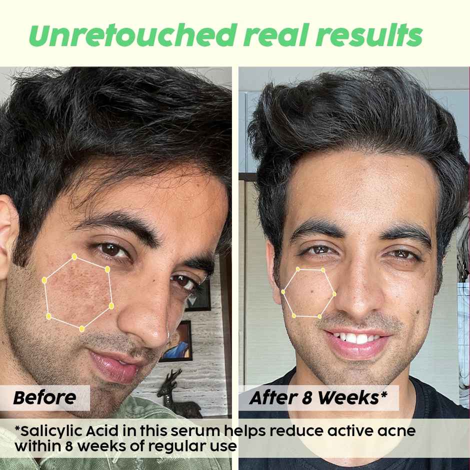 Plix The Plant Fix Jamun 2% Salicylic Acid Exfoliating Face Serum | For Active Acne & Blackheads