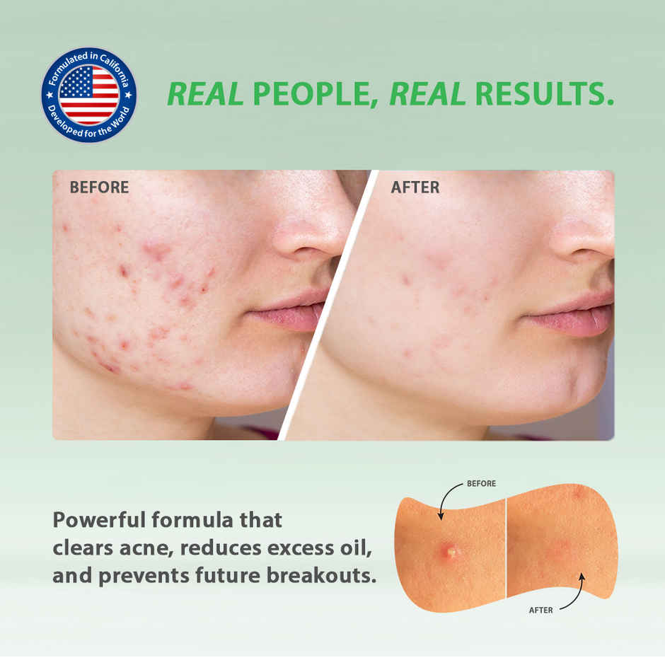 California Skin+ Triple Action Acne Relief Pimple Patches
