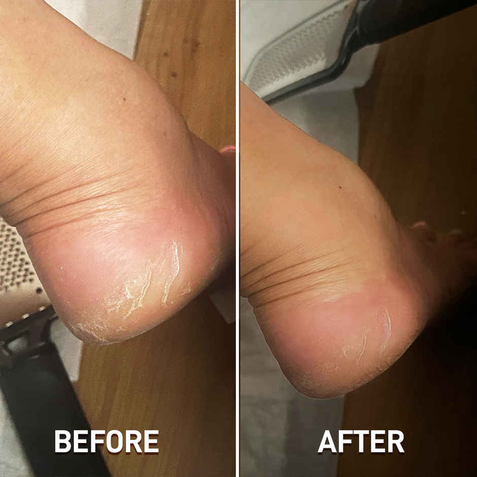 Gleva Callus Foot Scrubber Pedicure Kit for Dead Skin & Cracked Heel Removal Foot Spa For Women Men