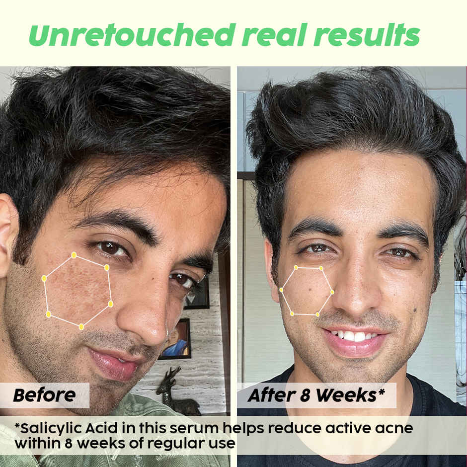 Plix The Plant Fix Jamun 2% Salicylic Acid Exfoliating Face Serum | For Active Acne & Blackheads