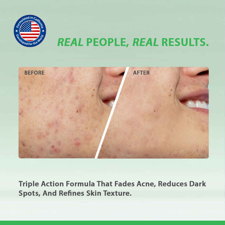 California Skin+ Triple Action Acne Scar Clear