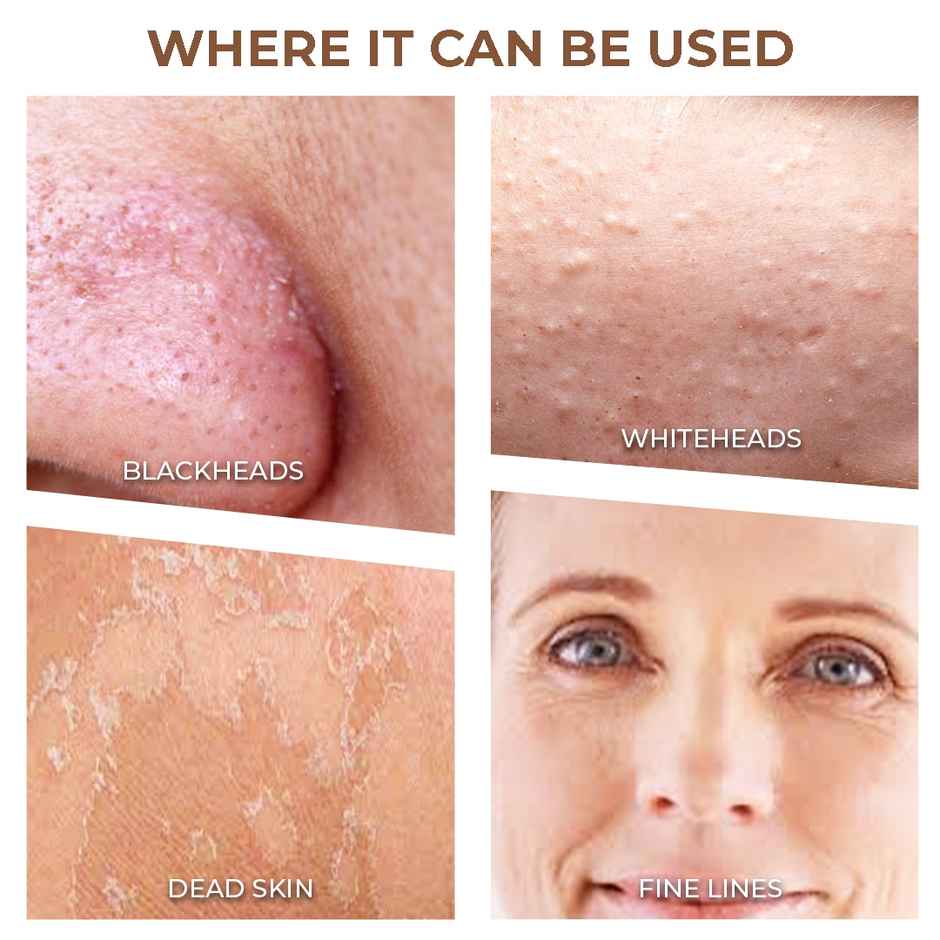 Winston Blackhead And Whitehead Remover Machine For Men And Women