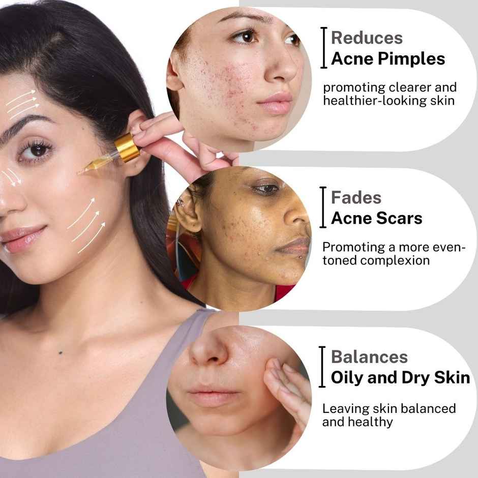 House of Beauty Acne Oil w/t Tea Tree, avocado & Vit-E for drying pimpled & oily skin (10ml)