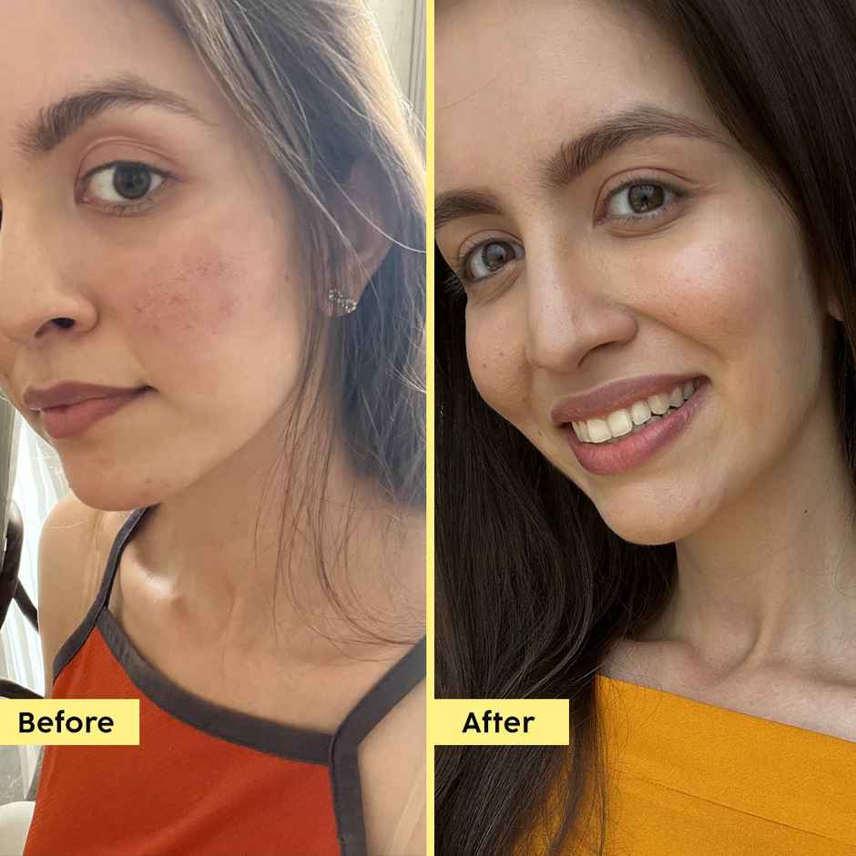 Plix Pineapple Face Serum with Alpha Arbutin for Pigmentation & Dark Spots