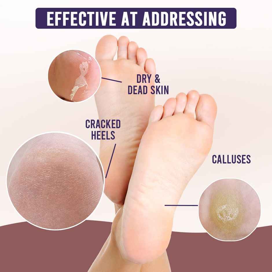 Sanfe Exfoliating Foot Mask | Exfoliates, Hydrates | Removes Dry Skin, Hard Calluses | 1 Pair