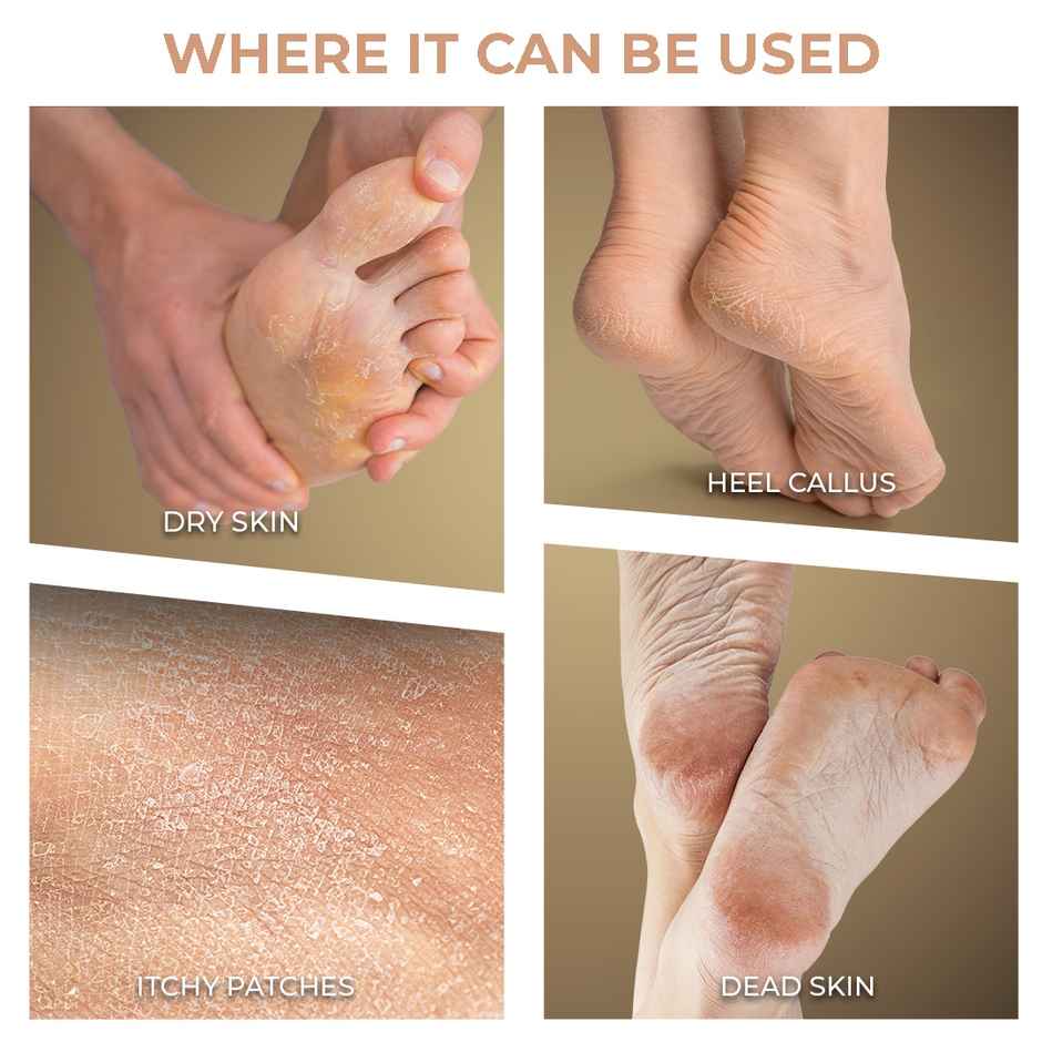 Winston Callus Remover For Feet For Men And Women
