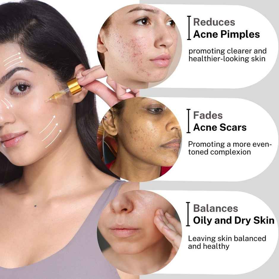 House of Beauty Acne Oil w/t Tea Tree, avocado & Vit-E for drying pimpled & oily skin (10ml)