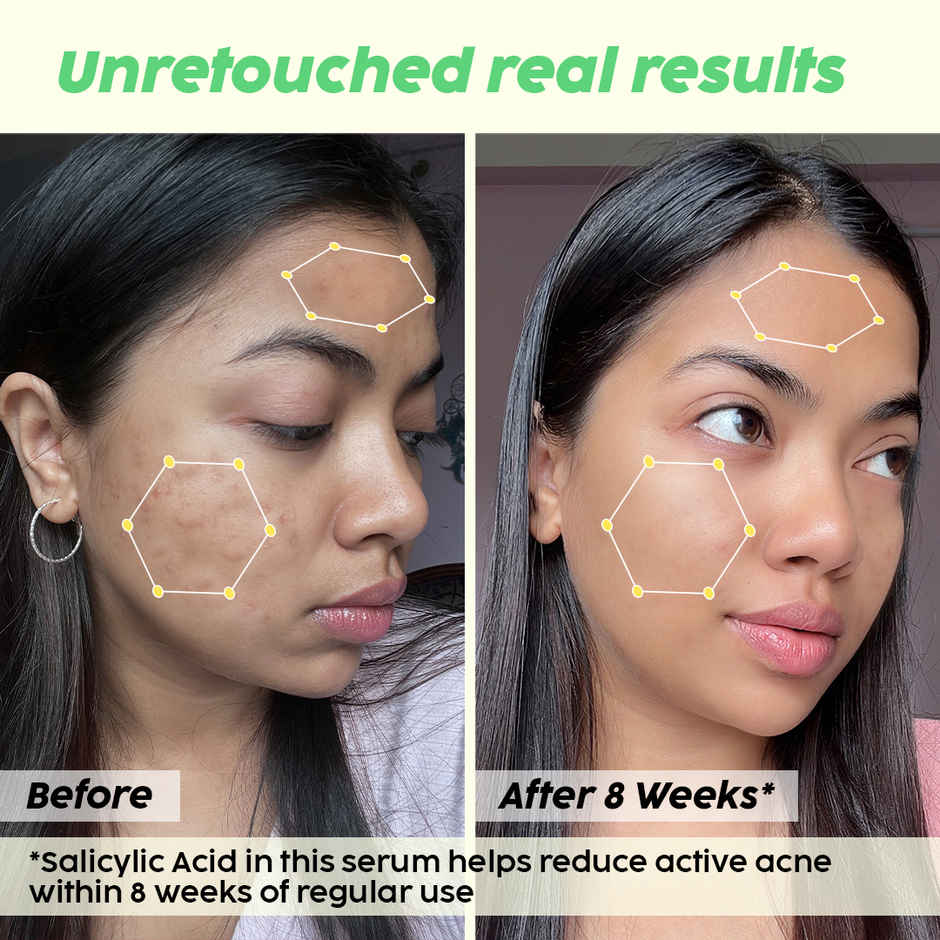 Plix The Plant Fix Jamun 2% Salicylic Acid Exfoliating Face Serum | For Active Acne & Blackheads