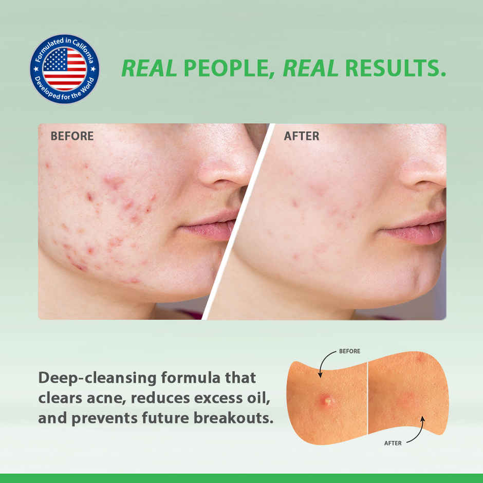 California Skin+ Acne Control Face Wash Cleanser