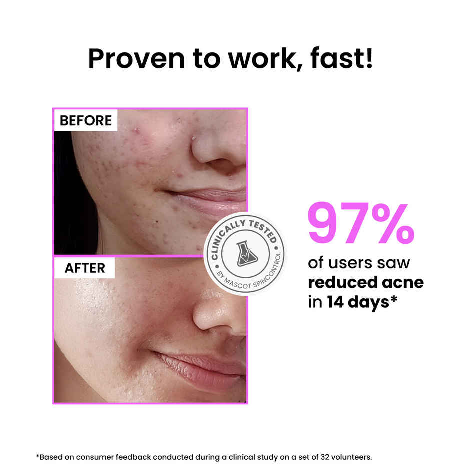 Foxtale 12% Niacinamide Face Serum with Azelaic Acid | Reduces Acne & Blemishes