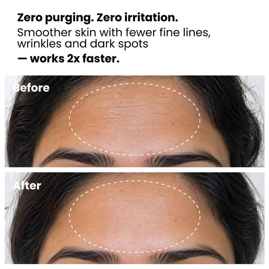 Foxtale 0.15% Retinol Anti Ageing Face Serum, Reduces Wrinkles