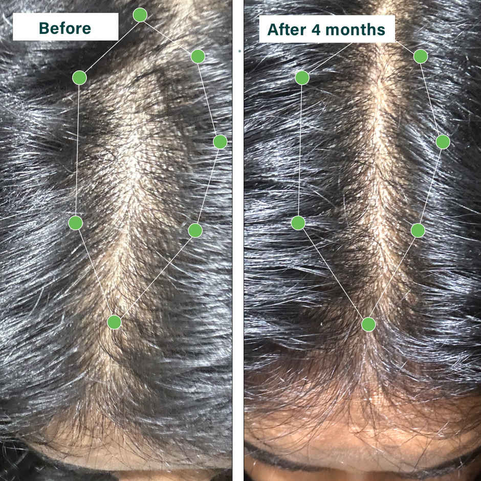 Oziva Hair Vitamins with Biotin, Iron and DHT Blocker for Hair Growth and Hairfall Control