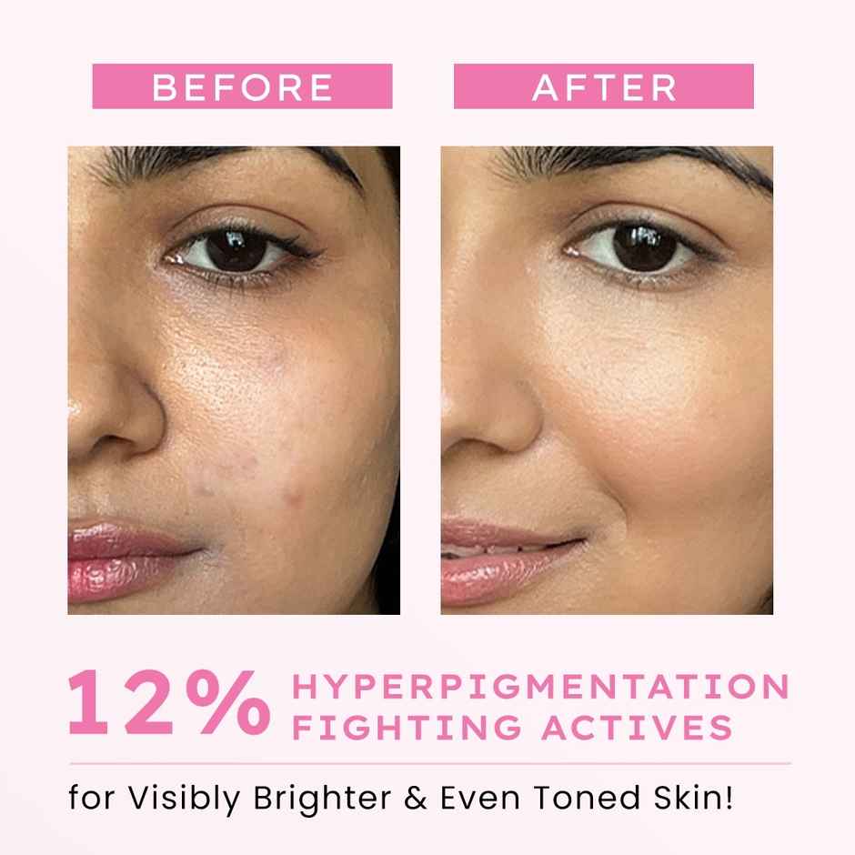 Hyphen Advanced De-Pigmentation Serum For Hyperpigmentation | Melasma Dark Spots & Scars