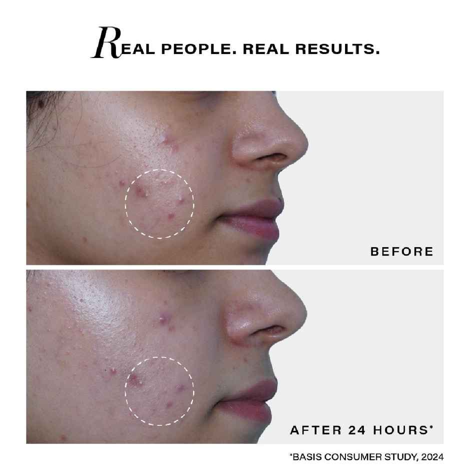 Novology Acne Spot Corrector | Fights Active Acne | Whiteheads | Pimples | For Acne Prone Skin