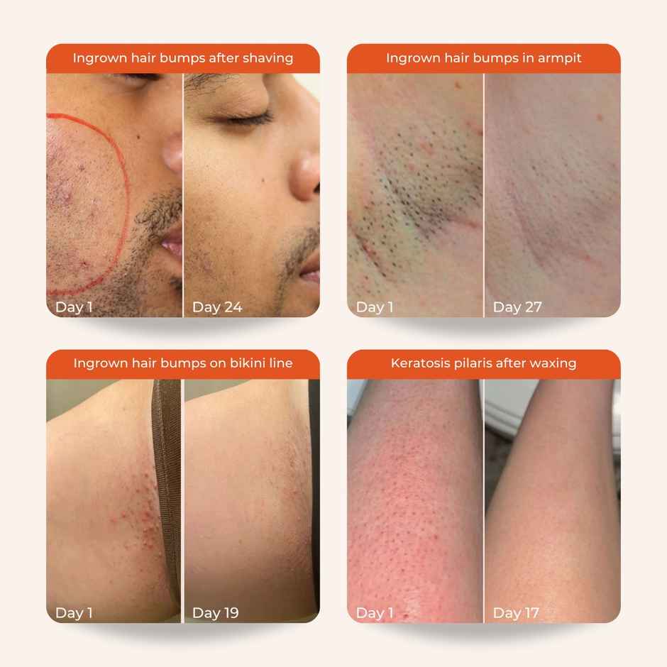 Skinvest Bye Bye Bumps For Men & Women