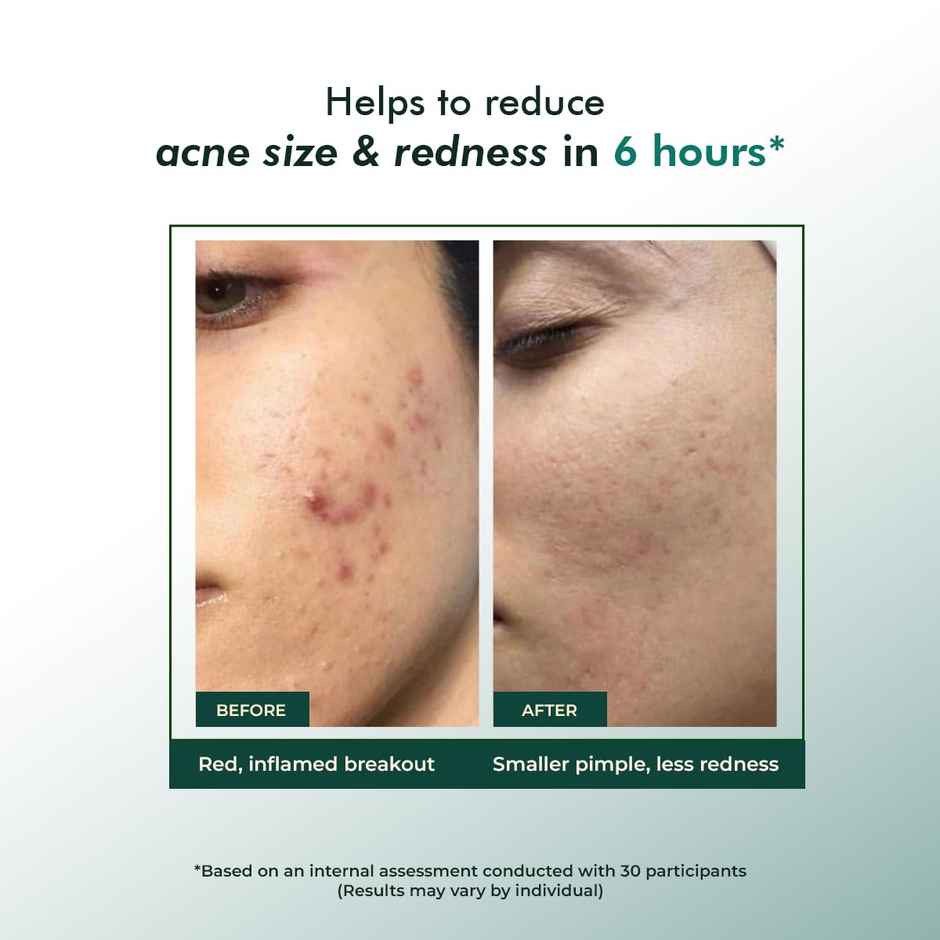 Conscious Chemist Rapid Relief Acne Spot Corrector Gel with Salicylic & Azelaic Acid for Clear Skin