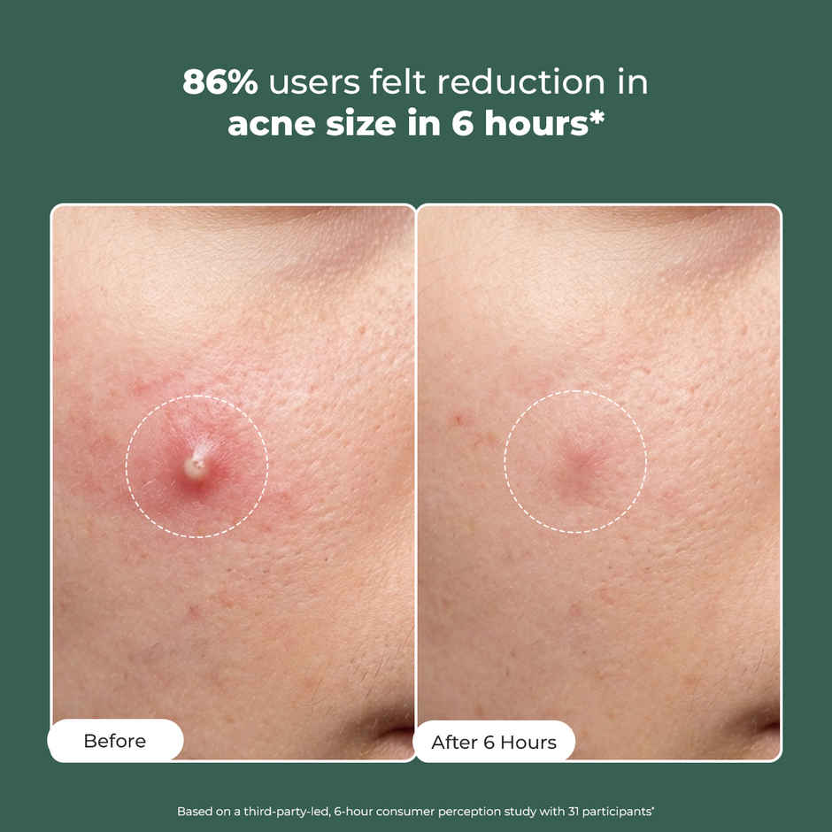 Conscious Chemist Rapid Relief Acne Spot Corrector Gel with Salicylic & Azelaic Acid for Clear Skin