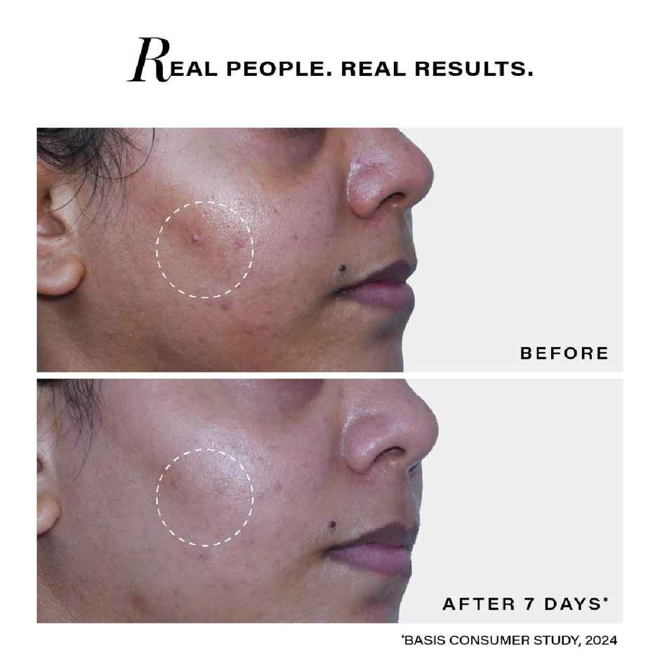 Novology Acne Clearing Cleanser For Acne, Whiteheads And Blackheads|Suitable For Sensitive Skin