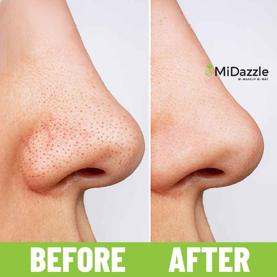 Midazzle Stainless Steel Blackhead & Whitehead Remover Face Care Tool |MIBR3301