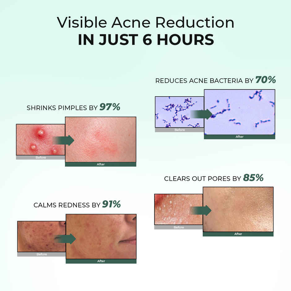 Conscious Chemist Rapid Relief Acne Spot Corrector Gel with Salicylic & Azelaic Acid for Clear Skin