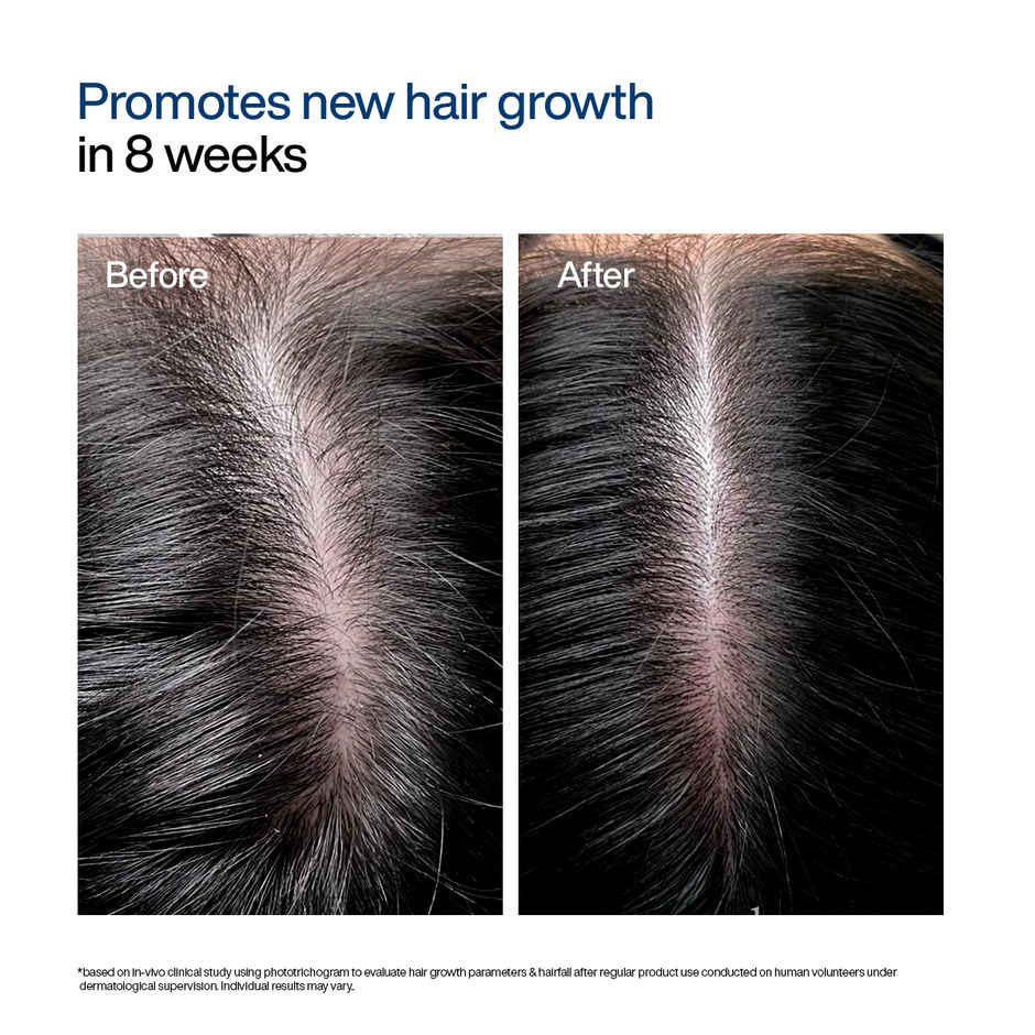 WishCare Hair Growth Serum Concentrate | New Hair Growth in 8 weeks | Redensyl, Anagain & Rosemary