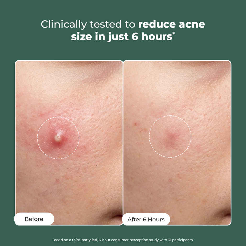 Conscious Chemist Rapid Relief Acne Spot Corrector Gel with Salicylic & Azelaic Acid for Clear Skin