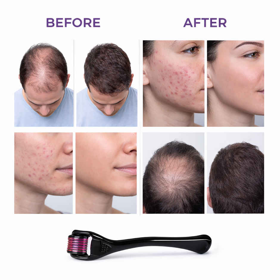 Prolume Derma Face Roller | 0.5 mm | Boosts Skin Radiance