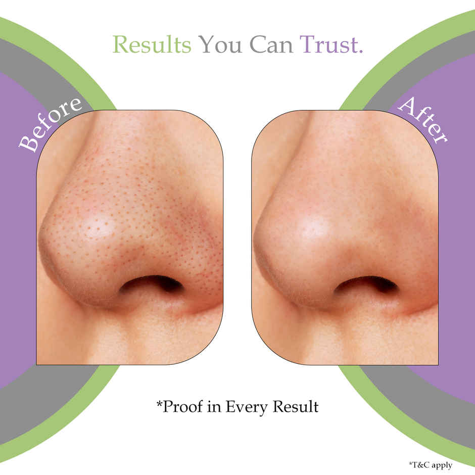 Sanfe DeepDetox 3 in 1 Nose Strips for Blackhead Removal