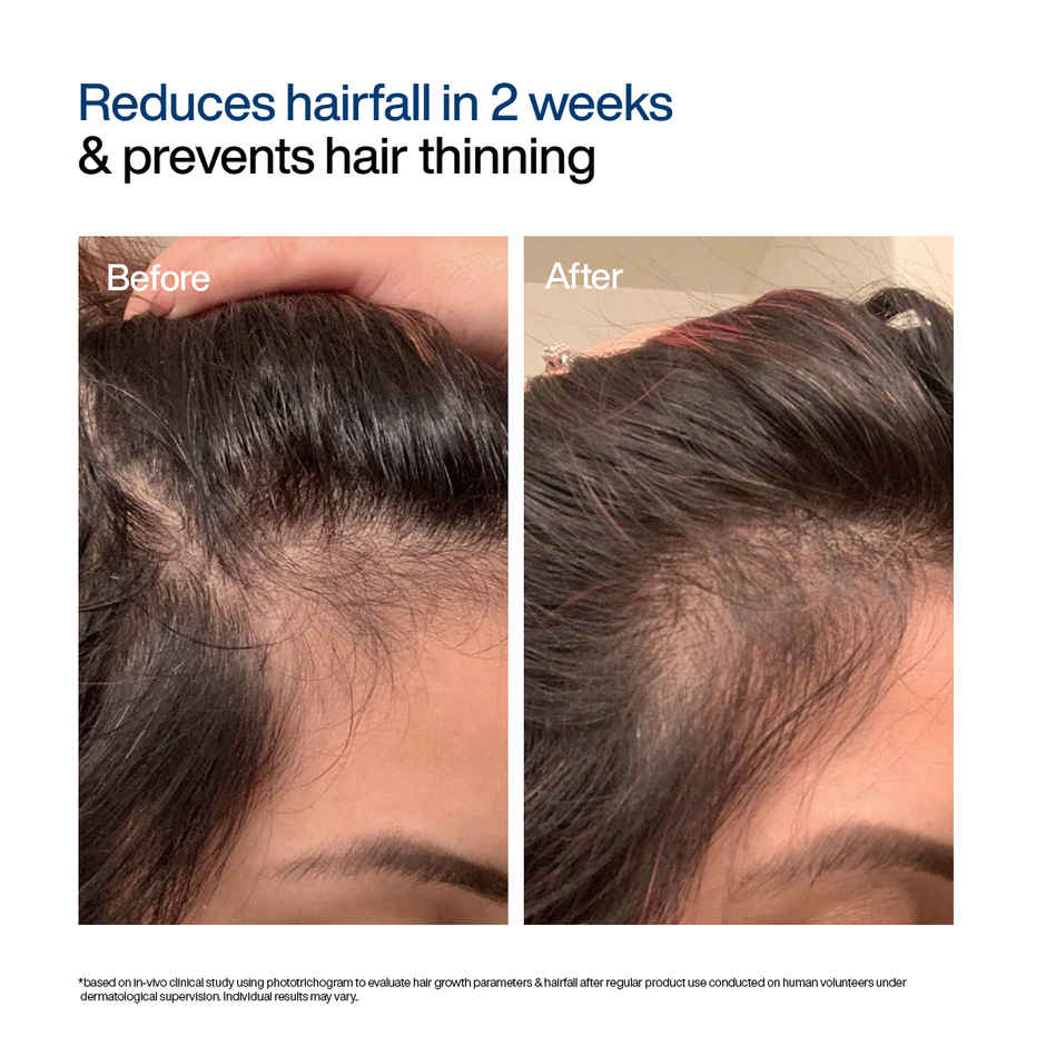 WishCare Hair Growth Serum Concentrate | New Hair Growth in 8 weeks | Redensyl, Anagain & Rosemary