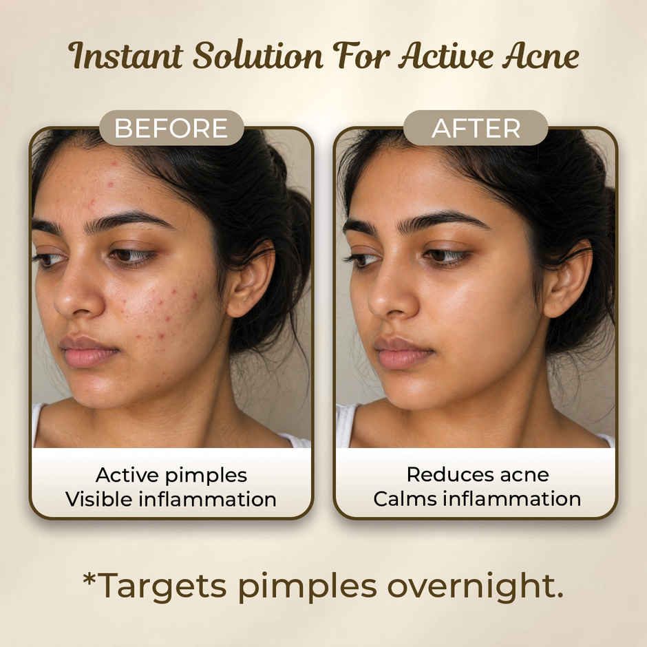 Sanfe Pimple Patches Fast-Acting Overnight Acne Patch