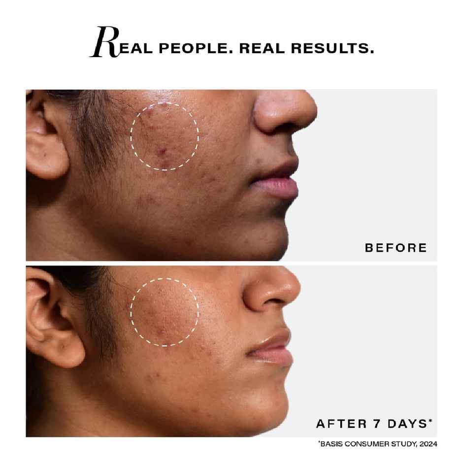 Novology Acne Clearing Serum With Thymol And Terpineol | Non-Drying, Non-Irritating