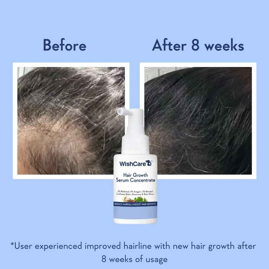 Wishcare Hair Growth Serum Concentrate - Resdensyl, Anagain, Caffeine, Biotin, Keratin & Rice Water