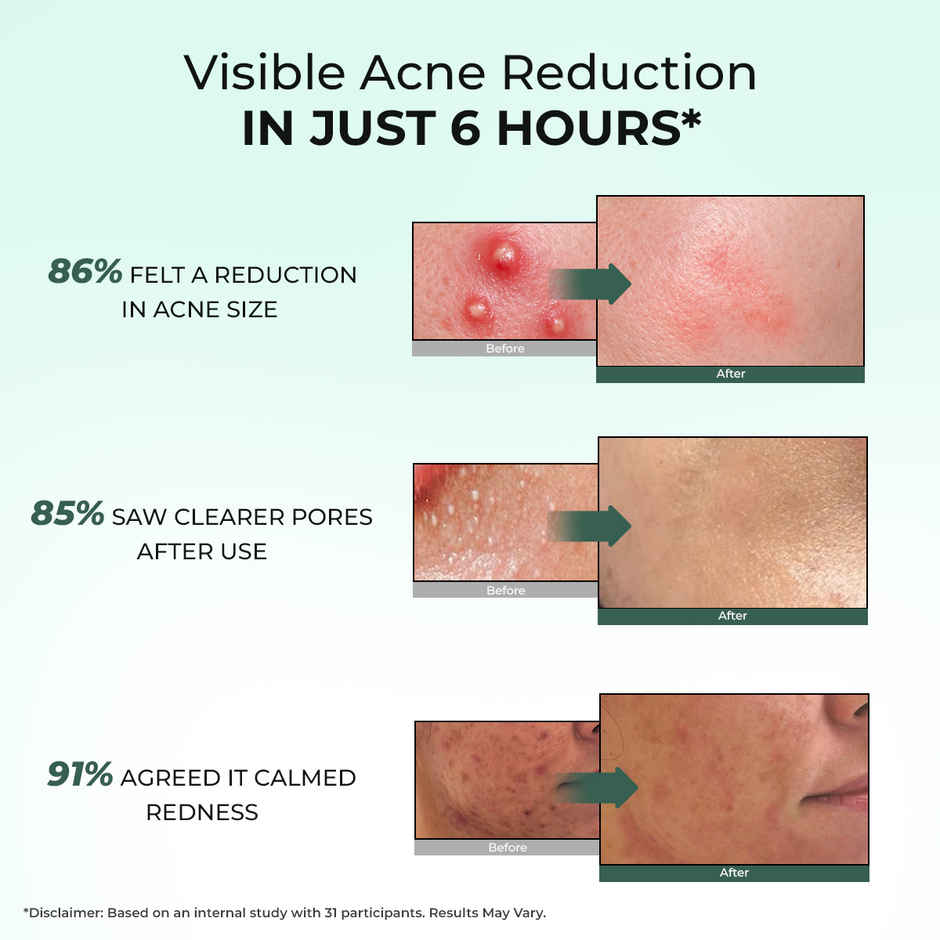 Conscious Chemist Rapid Relief Acne Spot Corrector Gel with Salicylic & Azelaic Acid for Clear Skin