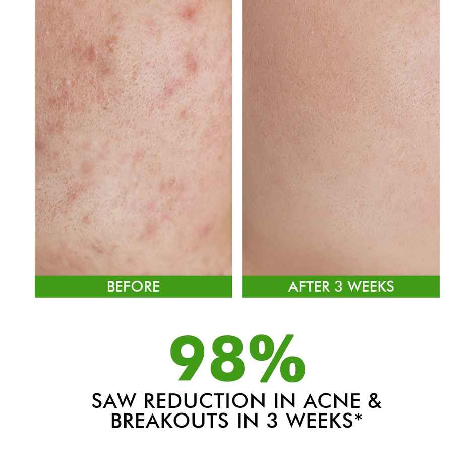 Conscious Chemist 2% Salicylic Acid Acne Treatment Serum For Acne, Blackheads & Open Pores