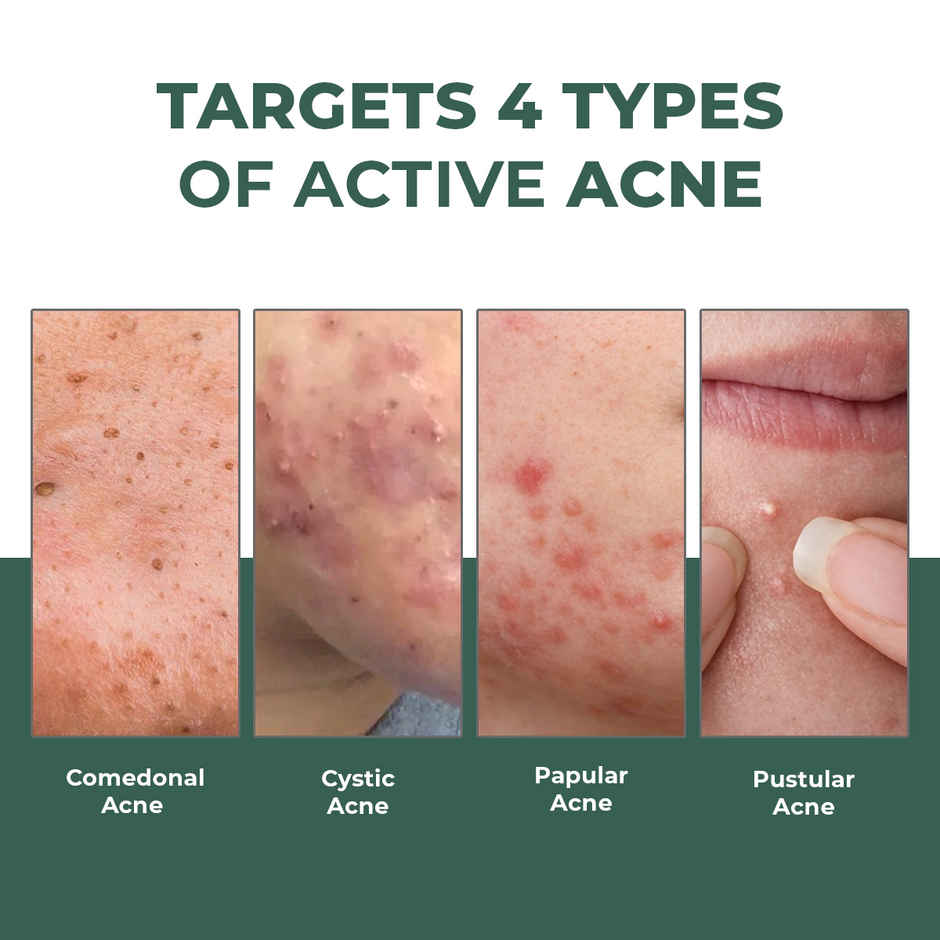 Conscious Chemist Rapid Relief Acne Spot Corrector Gel with Salicylic & Azelaic Acid for Clear Skin